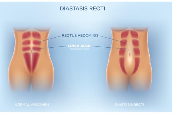 What Non-Surgical Options Are Available for Diastasis Recti Salford?