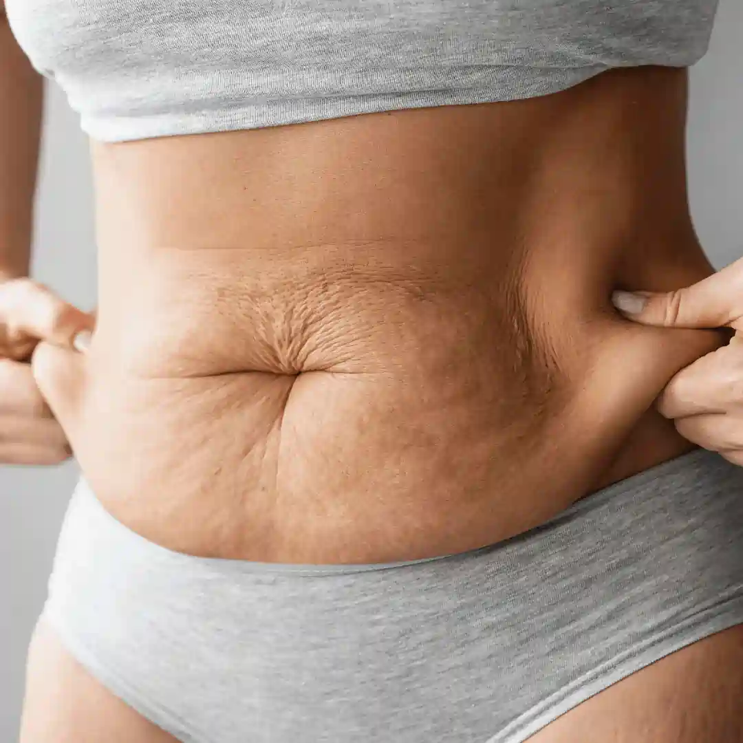Is It Normal to Have Loose Skin After Pregnancy Salford?
